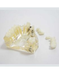 dental implant models for patient education