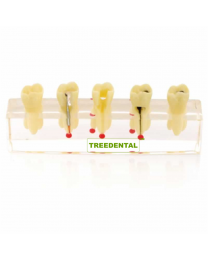 Rootcanal Treatment Model,Typodont Teeth In Dentistry