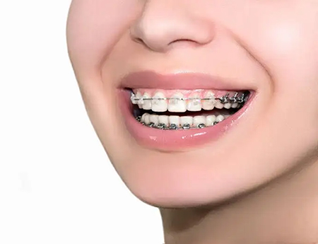 This blog will take you through orthodontic products!