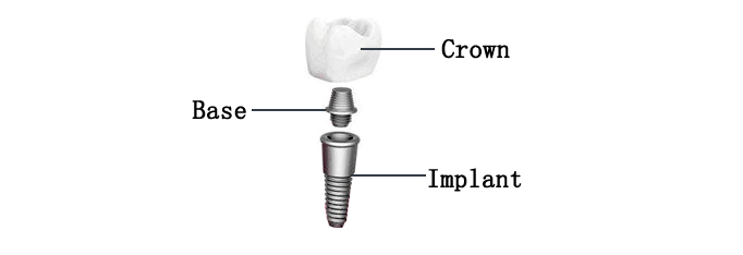Dental Implant Torque Wrench